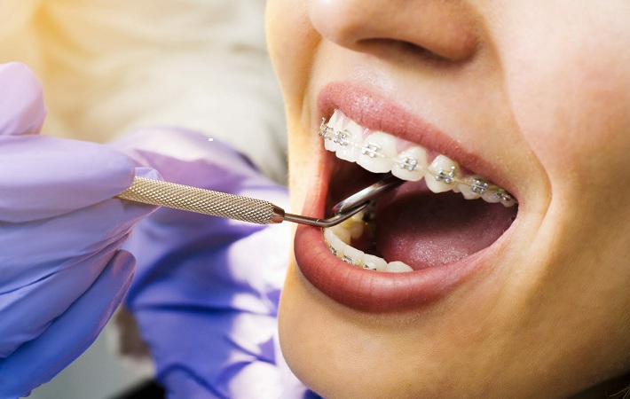 Professional Orthodontist For Quality Dental Braces Treatment